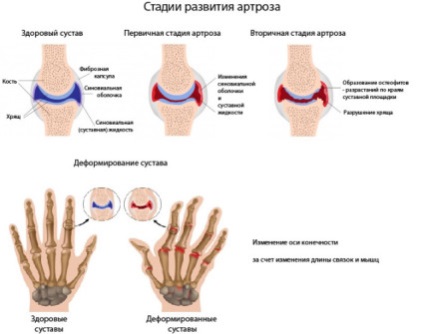 Artroza posttraumatică a manifestării, diagnosticului, tratamentului