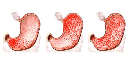 Gastrita superficială, ce este, simptomele și cum să o tratezi - enciclopedia medicală