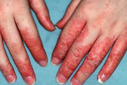 Există un blister pe piele a ceea ce se va întâmpla dacă se zgârie, cauzele și tipurile de boli