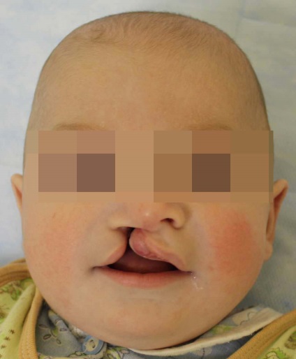 Tratamentul ortodontic pre-chirurgical al copiilor cu buza cleft și palate