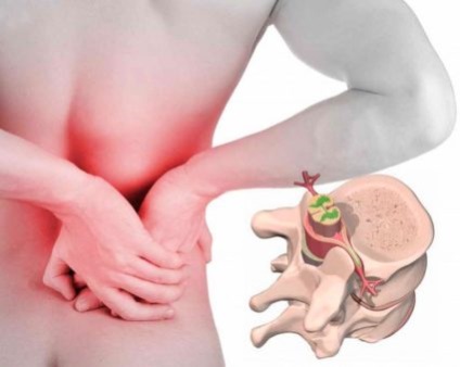 A herniated lumbalis gerinc jelzései és kezelése