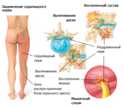 Признаци на херния на гръбначния стълб и нейното лечение