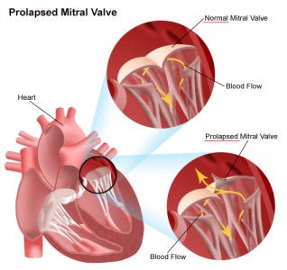 Diagnosticarea prolapsului valvei mitrale