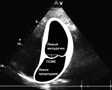 Diagnosticarea prolapsului valvei mitrale