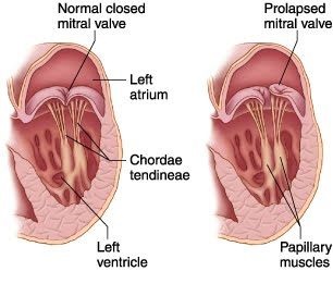 Diagnosticarea prolapsului valvei mitrale