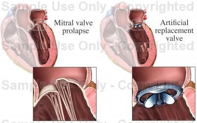 Diagnosticarea prolapsului valvei mitrale