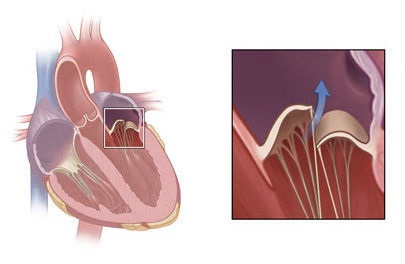 Diagnosticarea prolapsului valvei mitrale