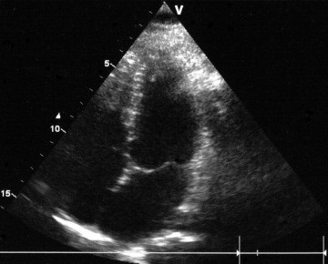 Diagnosticarea prolapsului valvei mitrale