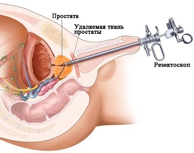 Chirurgia prostatitei - care sunt motivele pentru un astfel de tratament, ce alte metode sunt folosite în plus