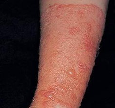 Dermatita simplă a dermatitei de contact, simptome, diagnostic și tratament