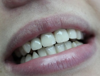 Protetikus fogászat, árak - fogorvosok novadent