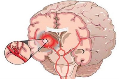 Reabilitarea după accident vascular cerebral ischemic la domiciliu, tratament restabilitor