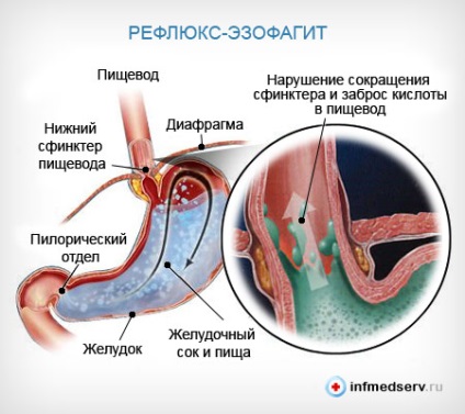 Reflux-esofagită simptome și tratament