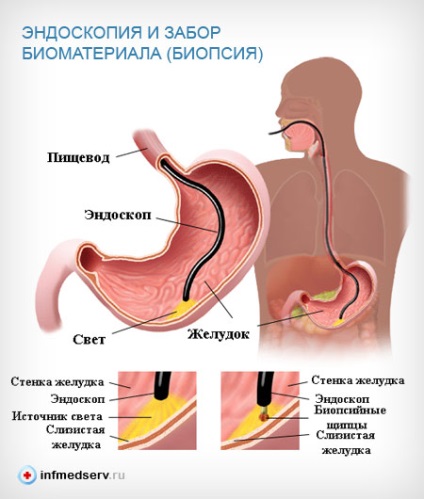 Reflux-esofagită simptome și tratament