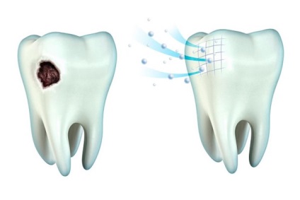 A fogak remineralizálása, a cselekvés elve, fogászat és otthon