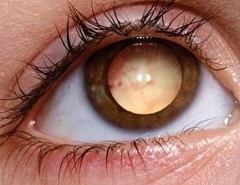 Retinoblastomul la copii - tratament, etape, simptome