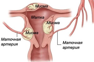 A méh mióma tünetei (jelek)