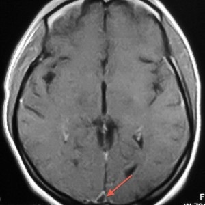 Tromboză sinusală - tromboză a duratei dura mater, trombanet