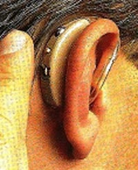Ajutoare auditive care folosesc sunete de conducere osoasă, un centru de reabilitare pediatrică