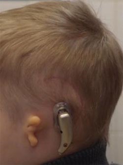 Hallókészülékek csontvezető hangok használatával, gyermekgyógyászati ​​rehabilitációs központ