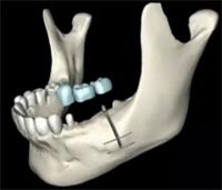 Metode moderne de implantare a dinților