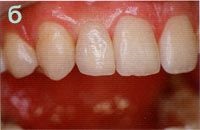 Articole despre stomatologie cbw-system - proteze fără răsucirea dinților