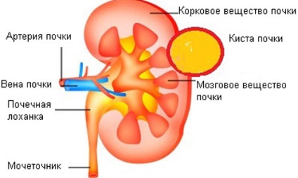 Merită meritat tratarea chistului renal dacă nu se deranjează