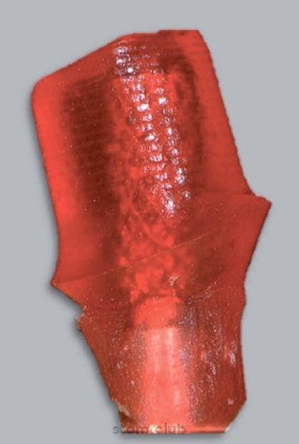Stomweb - cikk - cementált helyreállítás egy implantátumon