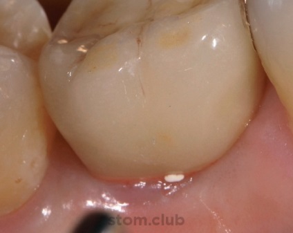 Stomweb - cikk - cementált helyreállítás egy implantátumon