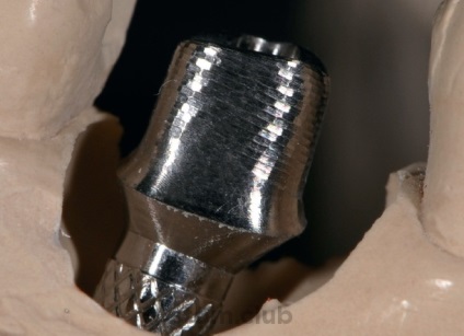 Stomweb - articol - restaurare cimentată pe un implant