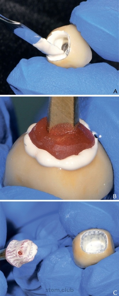 Stomweb - cikk - cementált helyreállítás egy implantátumon