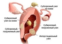 Miomul uterin submucos - cauzele debutului, manifestările clinice, complicațiile, tratamentul