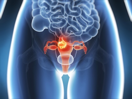 Simptome fibroame uterine submucoase și tratamentul bolii