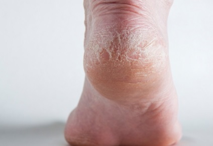 Pielea uscată a picioarelor se datorează metabolismului afectat