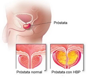 Afalah comprimate pentru tratamentul adenomului și prostatitei, recenzii, instrucțiuni, preț, indicații de utilizare