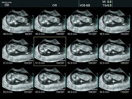 Tehnologie msv (multislaying) - tomografie cu ultrasunete