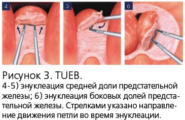 Enuclearea transuretrală a prostatei (tueb) este o nouă metodă de endoscopie bipolară