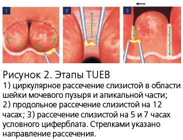 Enuclearea transuretrală a prostatei (tueb) este o nouă metodă de endoscopie bipolară