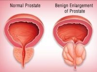 Rezecția transuretrală a prostatei și a adenomului, ce este, revizuirile, costul și consecințele operației