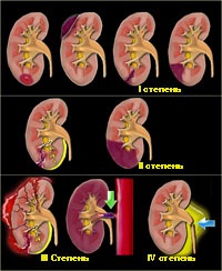 Leziuni ale rinichiului, urologul meu