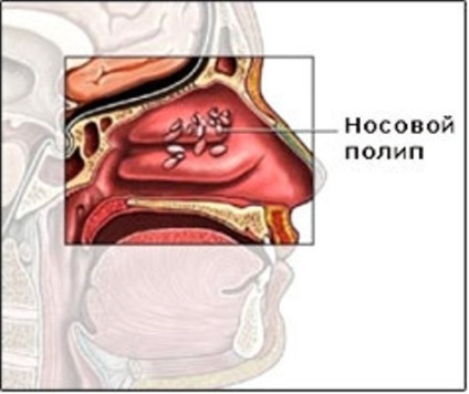 Eliminarea polipilor în nas, prețurile pentru îndepărtarea polipilor nazali în clinica proflortsentr