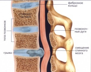 Terapia cu valuri de șoc cu coloană herniată