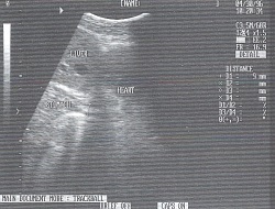 Diagnosticarea cu ultrasunete a achalaziei cardiace - burkov cu