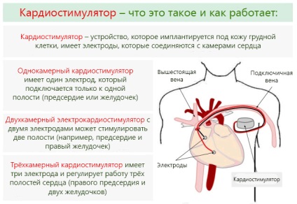 Instalația stimulatorului cardiac - funcționarea și contraindicațiile după vârstă