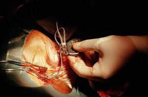Szív pacemaker telepítés - működés és ellenjavallatok kor szerint