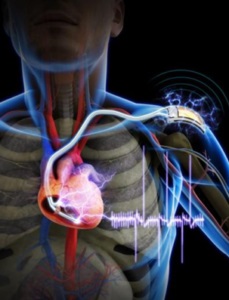 Instalația stimulatorului cardiac - funcționarea și contraindicațiile după vârstă