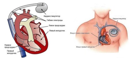 Instalația stimulatorului cardiac - funcționarea și contraindicațiile după vârstă