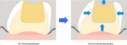Variante ale soluției problemei reale de restaurare a cavității în zona grupului de mestecat dinți