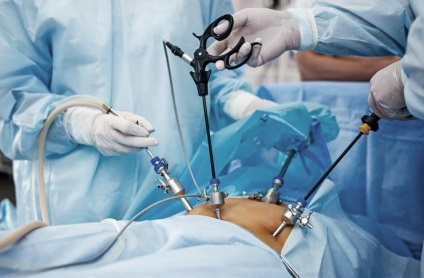 Alocațiile după laparoscopie sunt maro, galben, sângeroase după laparoscopia trompelor uterine