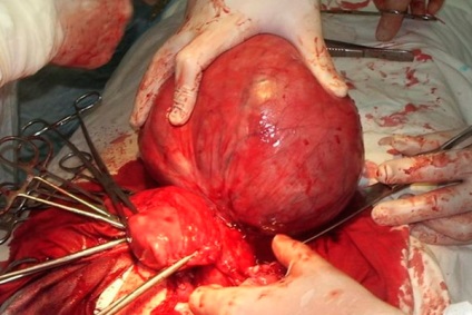 Alocațiile pentru miomul uterin sunt sângeroase, maro, galben
